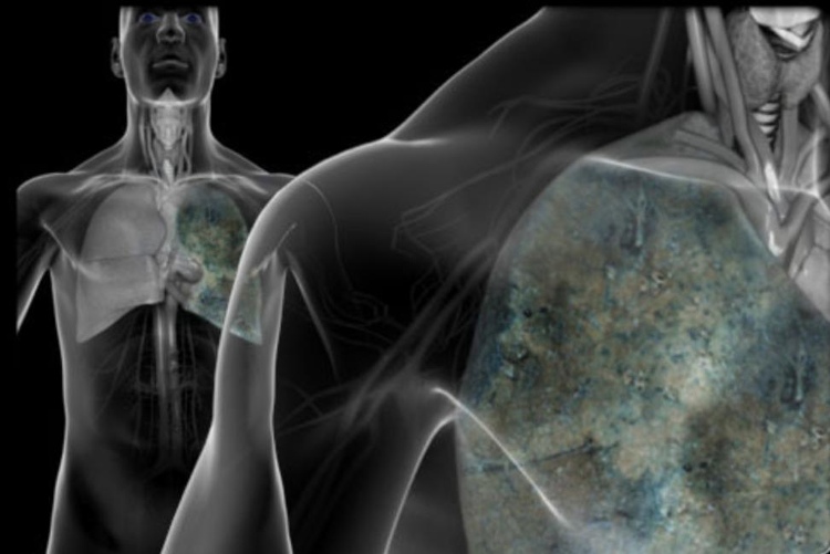 Ung thư phổi có biểu hiện đau ngực, khó thở và ho lâu ngày không khỏi.