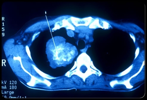 Hình ảnh tế bào ung thư phổi.