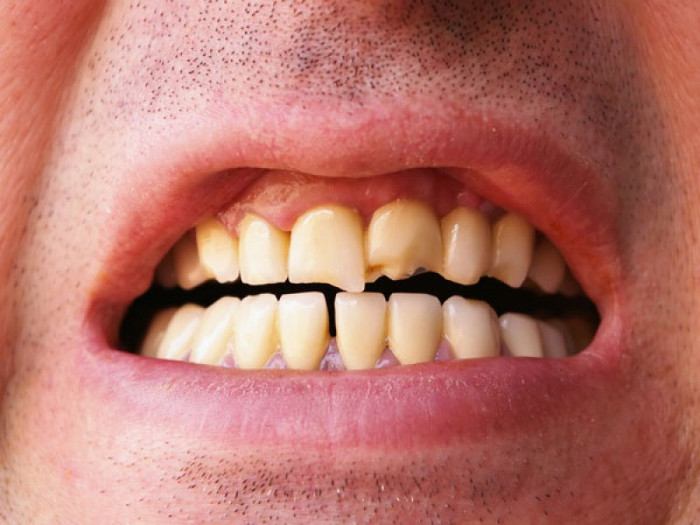 Dấu hiệu cảnh báo nồng độ axit trong cơ thể quá cao