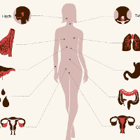 Các loại ung thư thường gặp ở phụ nữ Việt