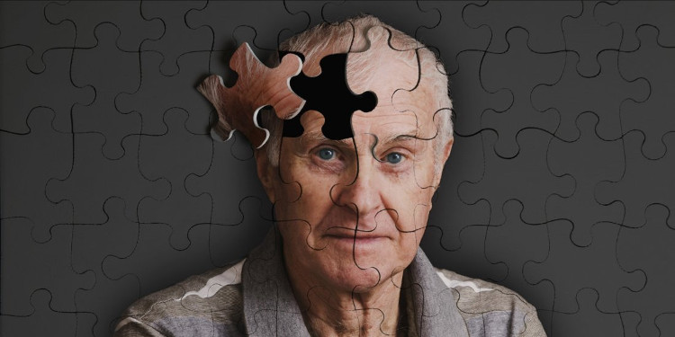 Bệnh nhân đầu tiên mang virus HIV sống lâu đến mức bị mắc Alzheimer