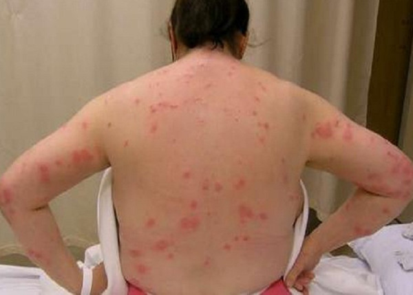 Bí quyết tiêu diệt rệp giường không dùng hóa chất