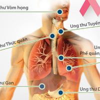 Người Việt ung thư dễ chết do thường phát hiện muộn