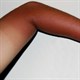 Điều gì thực sự đã xảy ra khi chúng ta bị cháy nắng?