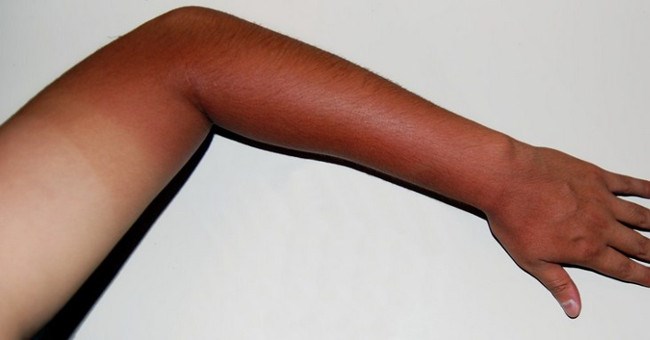 Điều gì thực sự đã xảy ra khi chúng ta bị cháy nắng?