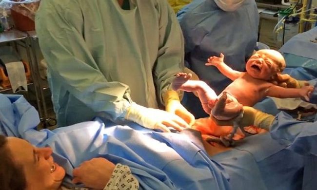 Em bé tự chui ra khỏi bụng mẹ trong ca sinh mổ tự nhiên