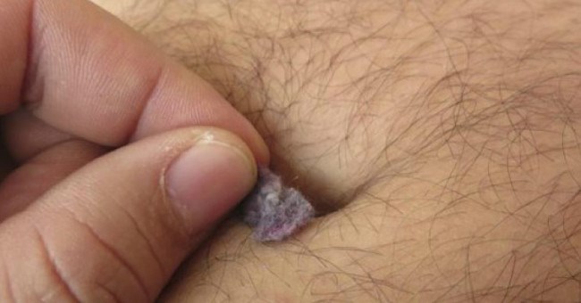 Sự thật bất ngờ về thứ cặn "siêu bẩn" trong rốn mà không phải ai cũng có