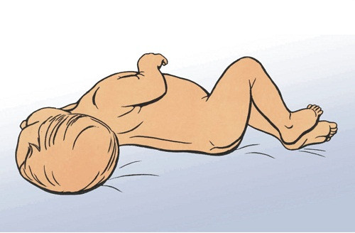 Hội chứng màng não là gì?