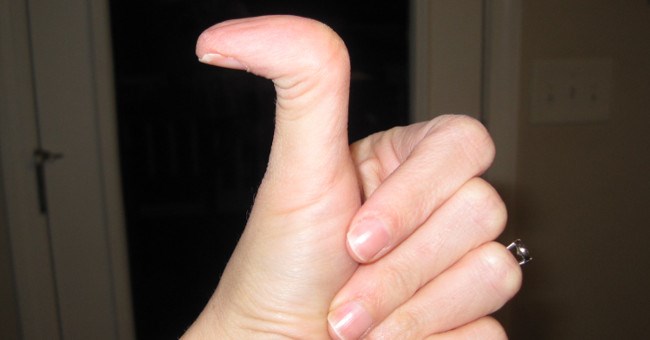 Những điều ít biết về người có ngón tay cái bẻ ngược