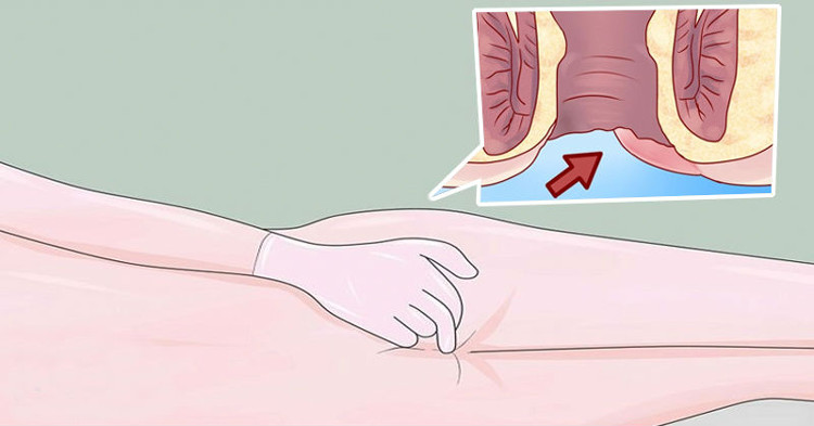 Dấu hiệu sớm cảnh báo bạn bị ung thư hậu môn
