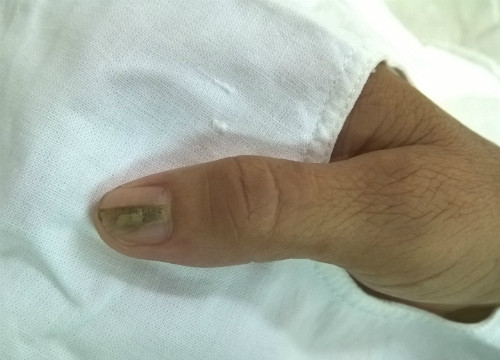 Móng tay có sọc coi chừng u cuộn mạch