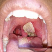 Viêm họng: Biểu hiện cực nguy hiểm của bệnh bạch hầu đang bùng phát