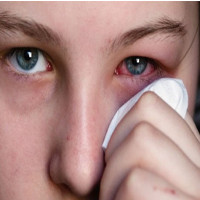 Tại sao đau mắt đỏ lây qua đường hô hấp?