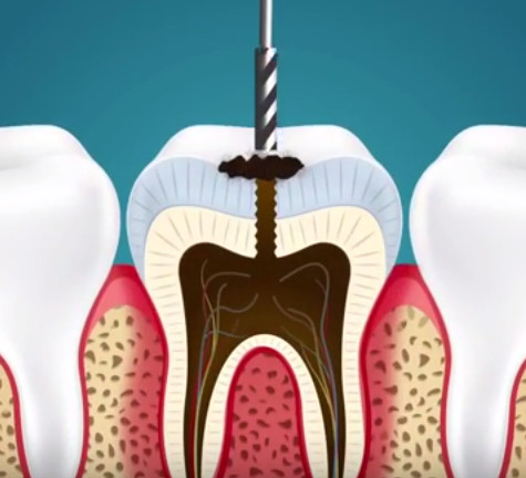 Mô phỏng quá trình chữa sâu răng.