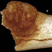 Phát hiện hóa thạch cho thấy ung thư đã có từ thời tiền sử