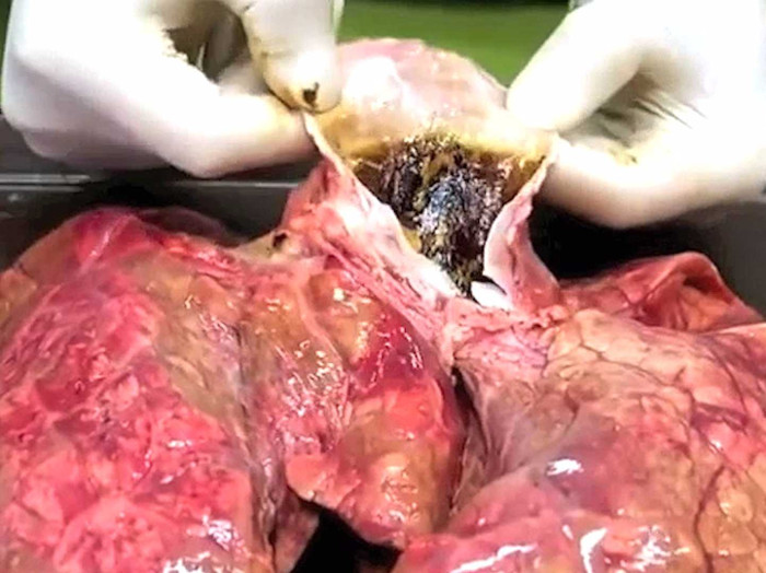 Sau khi hút 20 điếu thuốc lá, màu sắc lá phổi gần như biến đổi hoàn toàn.