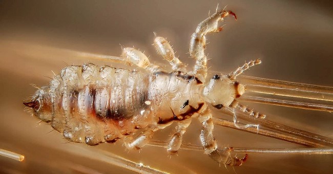 Đại dịch chấy tóc sắp bùng nổ khi 98% chấy rận đã kháng thuốc