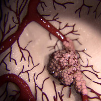 Video: Tận mắt xem các tế bào ung thư lan khắp cơ thể