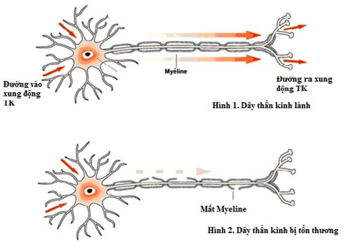 Liệt cơ tức thời bởi hội chứng Guillain - Barré
