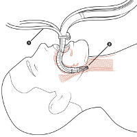 Flex - Robot rắn chui vào cơ thể qua đường miệng để phẫu thuật