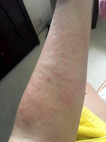 Cẩn trọng bệnh về da do đi mưa và lội nước ngập
