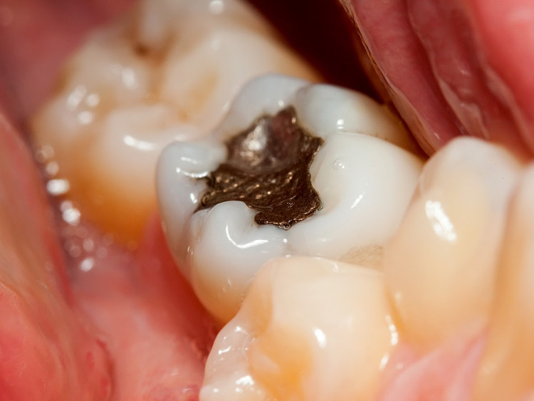 Hàn răng nhiều lần sẽ khiến bạn nhận một kết cục vô cùng đáng sợ