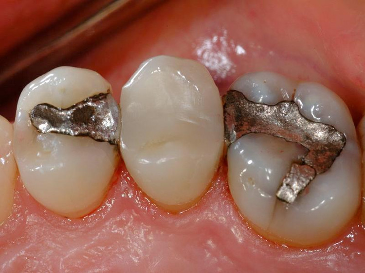 Hàn răng nhiều lần sẽ khiến bạn nhận một kết cục vô cùng đáng sợ