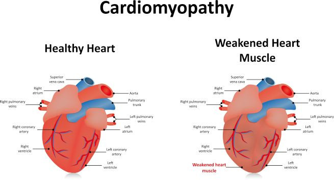 Chế độ ăn ít carb được cho là gây mất điện giải, từ đó có thể gây chuột rút và mệt mỏi.