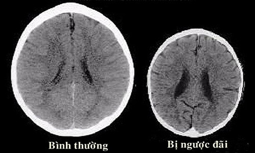 Trẻ em bị cha mẹ ngược đãi dễ bị teo não