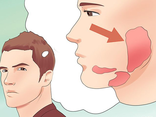 Biện pháp phòng và điều trị bệnh quai bị hiệu quả