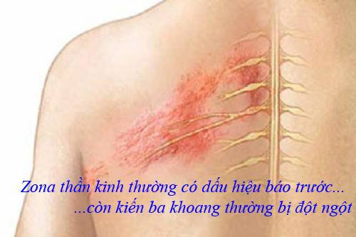 Cách xử lý vết thương do kiến ba khoang gây ra đơn giản mà nhanh
