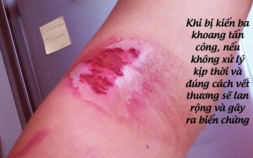 Cách xử lý vết thương do kiến ba khoang gây ra đơn giản mà nhanh