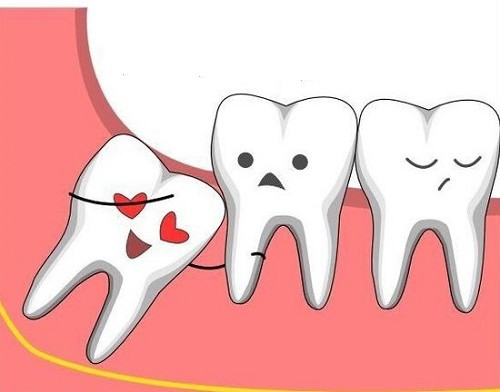 Nhổ răng khôn: Thoải mái hơn sau khi nhổ răng khôn để không còn cảm giác đau đớn khi ăn uống. Cùng xem hình ảnh liên quan để hiểu rõ hơn quá trình xoay vòng khó khăn của việc nhổ răng khôn!