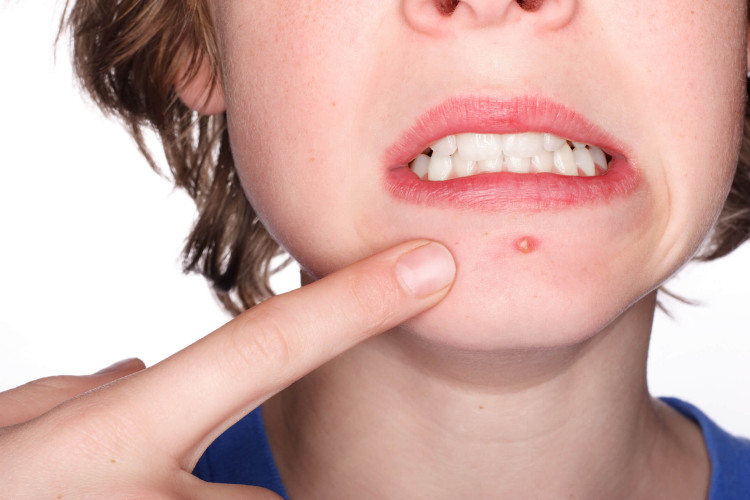Vì sao vi khuẩn chỉ gây mụn ở một số người?