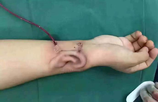 Bác sỹ Trung Quốc nuôi cấy tai trên tay bệnh nhân