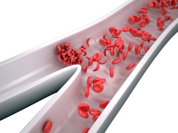 Bệnh hồng cầu hình liềm là tình trạng các tế bào hồng cầu trong máu không có hình dạng tròn mà thay vào đó có dạng hình lưỡi liềm.