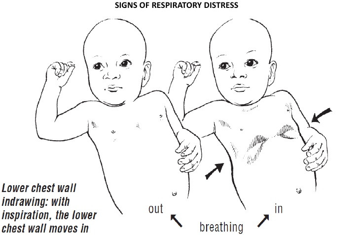 Trẻ viêm phổi đặc trưng với dấu hiệu co lõm lồng ngực khi thở.