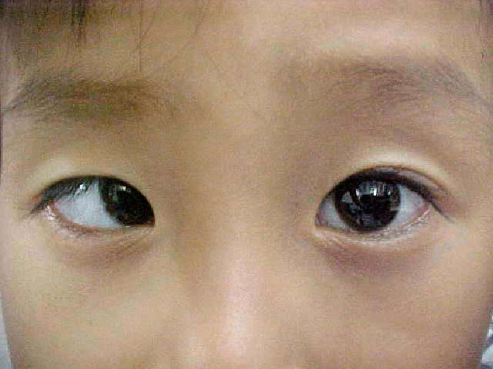 Sự nguy hiểm của căn bệnh nhược thị mà không phải ai cũng biết
