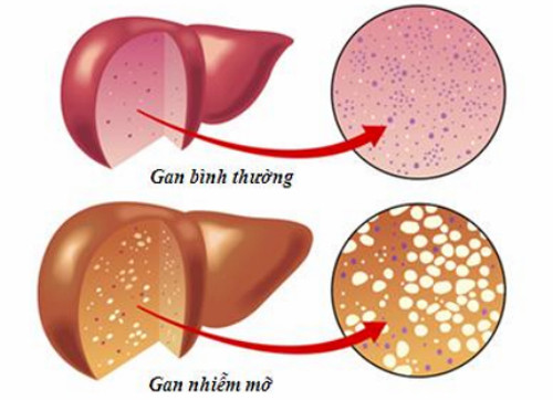 So sánh gan khỏe và gan nhiễm mỡ.