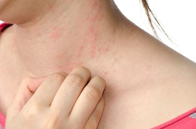 Vì sao bạn hay bị ngứa khi trời lạnh?