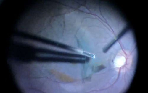 Kỹ thuật phẫu thuật mắt mới.