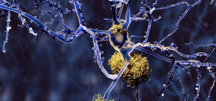 Alzheimer cũng có nhiều loại khác nhau