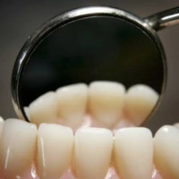 Loại thuốc chữa sâu răng mà không cần phải hàn răng
