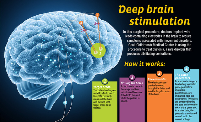 Kỹ thuật kích thích não sâu đã chữa được bệnh Parkinson, sắp tới có thể là Alzheimer và trầm cảm nữa