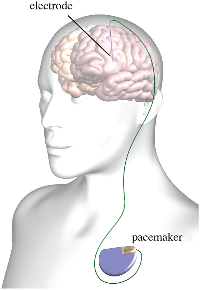 Kỹ thuật kích thích não sâu đã chữa được bệnh Parkinson, sắp tới có thể là Alzheimer và trầm cảm nữa