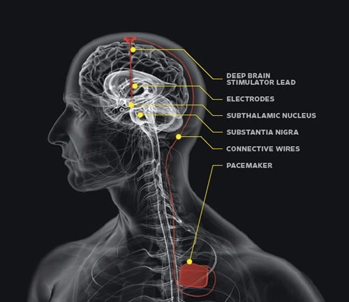 Kỹ thuật kích thích não sâu đã chữa được bệnh Parkinson, sắp tới có thể là Alzheimer và trầm cảm nữa