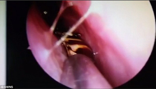 Sốc nặng khi phát hiện gián sống trong sọ