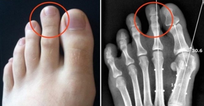 Ngón chân trỏ dài hơn ngón chân cái và cái kết chỉ 15% dân số thế giới phải chịu