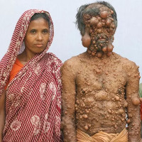 Người đàn ông "trăm u" bị xa lánh ở Bangladesh