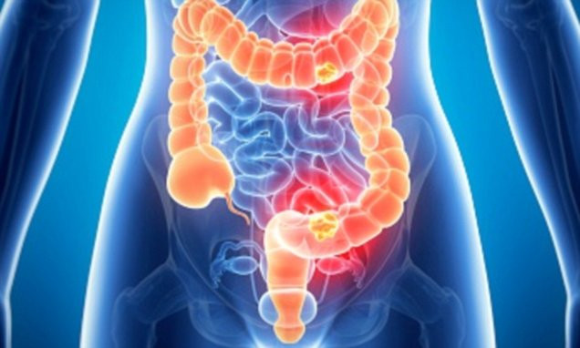 Nguyên nhân người trẻ bị ung thư ruột cao gấp 4 lần thế hệ trước